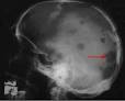 <b>Multiple myeloma</b> is named for