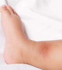 Image result for bed bug bites