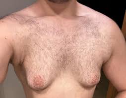 Image result for manboobs