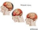Head trauma: MedlinePlus Medical Encyclopedia Image