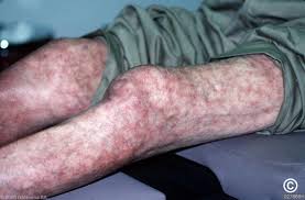 Attēlu rezultāti vaicājumam “Reticularia sp.”