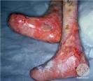 Epidermolysis Bullosa