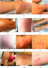 Image result for bed bug bites