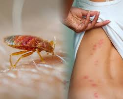 Image result for bed bug bites