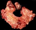Abdominal Neoplasms in Patients with Neurofibromatosis Type 1 ...