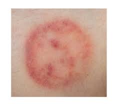 Image result for tinea corporis
