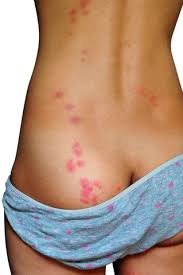 Image result for bed bug bites