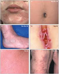 Attēlu rezultāti vaicājumam “Diderma simplex”