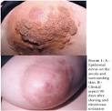 Anais Brasileiros de Dermatologia - Verrucous epidermal nevus ...