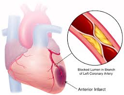  كيف نميز اعراض النوبة القلبية عن غيرها من النوبات؟‎ Images?q=tbn:ANd9GcTdf7IfkqrpUXXi8uplvnfnJOLn-oXhsGfT1C417mAaV6UuOkrGRA