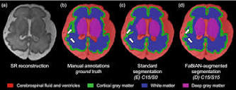 A Fetal Brain magnetic resonance Acquisition Numerical phantom ...