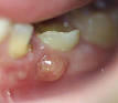 Un <b>abcès</b> est une infection