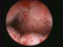 <b>Bladder tumor</b>