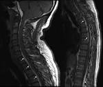 Migrating <b>Subdural Hematoma</b>