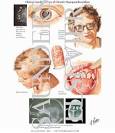 Chronic <b>Hypoparathyroidism</b>