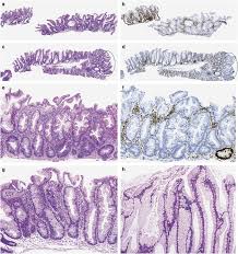 Attēlu rezultāti vaicājumam “Diderma simplex sessile”