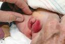 Hermaphrodite Infant | Consultant for Pediatricians
