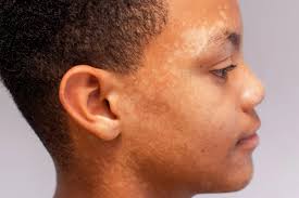 Image result for tinea corporis