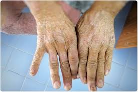 Attēlu rezultāti vaicājumam “Scleroderma”