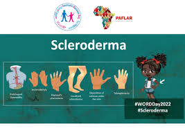 Attēlu rezultāti vaicājumam “Scleroderma”