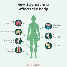 Attēlu rezultāti vaicājumam “Scleroderma”