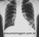 <b>Abscesso pulmonar</b>.