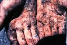 ARSENIC Toxicity