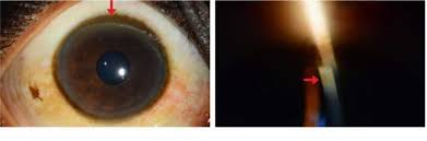 Kuvahaun tulos haulle Kayser-Fleischer