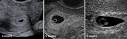 Early-Pregnancy-Scan-e ...