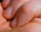 What is hangnail? « Nails@