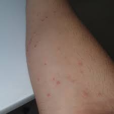 Image result for bed bug bites