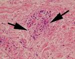 <b>Churg</b>-<b>Strauss syndrome</b> in a
