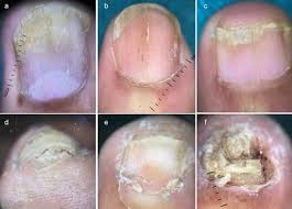 Attēlu rezultāti vaicājumam “Pemphigus borealis”