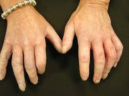 Attēlu rezultāti vaicājumam “Scleroderma”