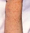 Idiopathic thrombocytopenic purpura (