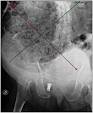 Fecal impaction - Wikipedia, the free encyclopedia