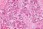 <b>hepatocellular carcinoma</b>