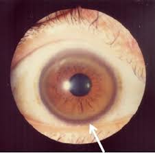 Kuvahaun tulos haulle Kayser-Fleischer