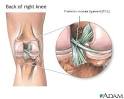 Posterior cruciate ligament of the knee: MedlinePlus Medical ...