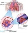 PULMONARY EMBOLISM - diagnosis, symptoms and treatment | Health ...