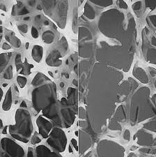 Osteoporosis