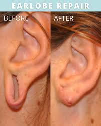 Image result for rupaljanuj