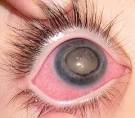 mild <b>corneal edema</b>,