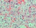 Inicialmente los <b>adenomas</b>