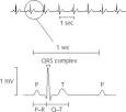 electrocardiogram: Definition from Answers.