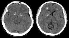 File:Brain computer tomography cuts of the patient with 22q11.2 ...