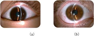 Kuvahaun tulos haulle Kayser-Fleischer