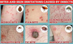 Image result for bed bug bites