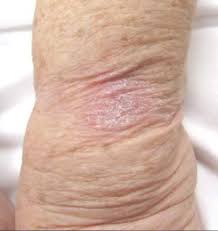 Image result for tinea corporis