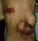 Part 1: Symptom control in the management of fungating wounds